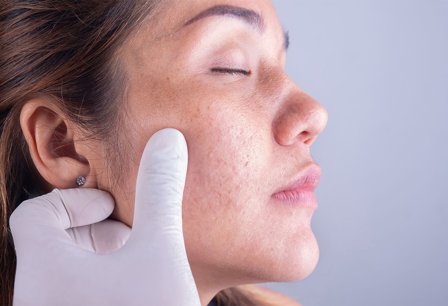 Why Dermatologists & Estheticians Recommend Volcanic Exfoliation